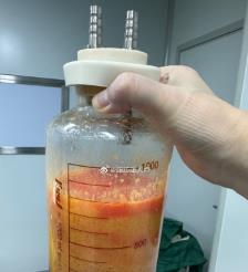 吉安水动力吸脂手术要做多久？